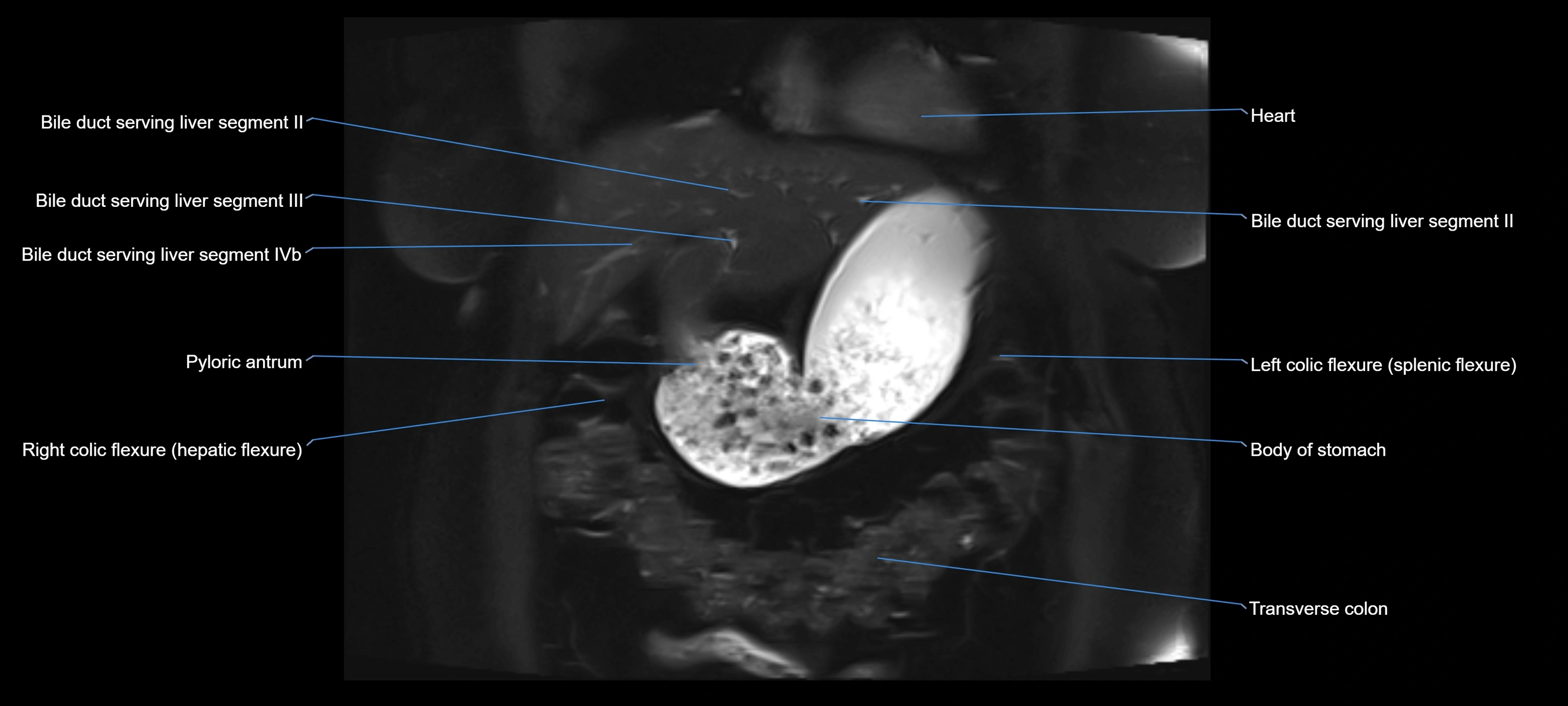 MRI MRCP coronal cross sectional 3T radiology  image-img-00001-00003.webp